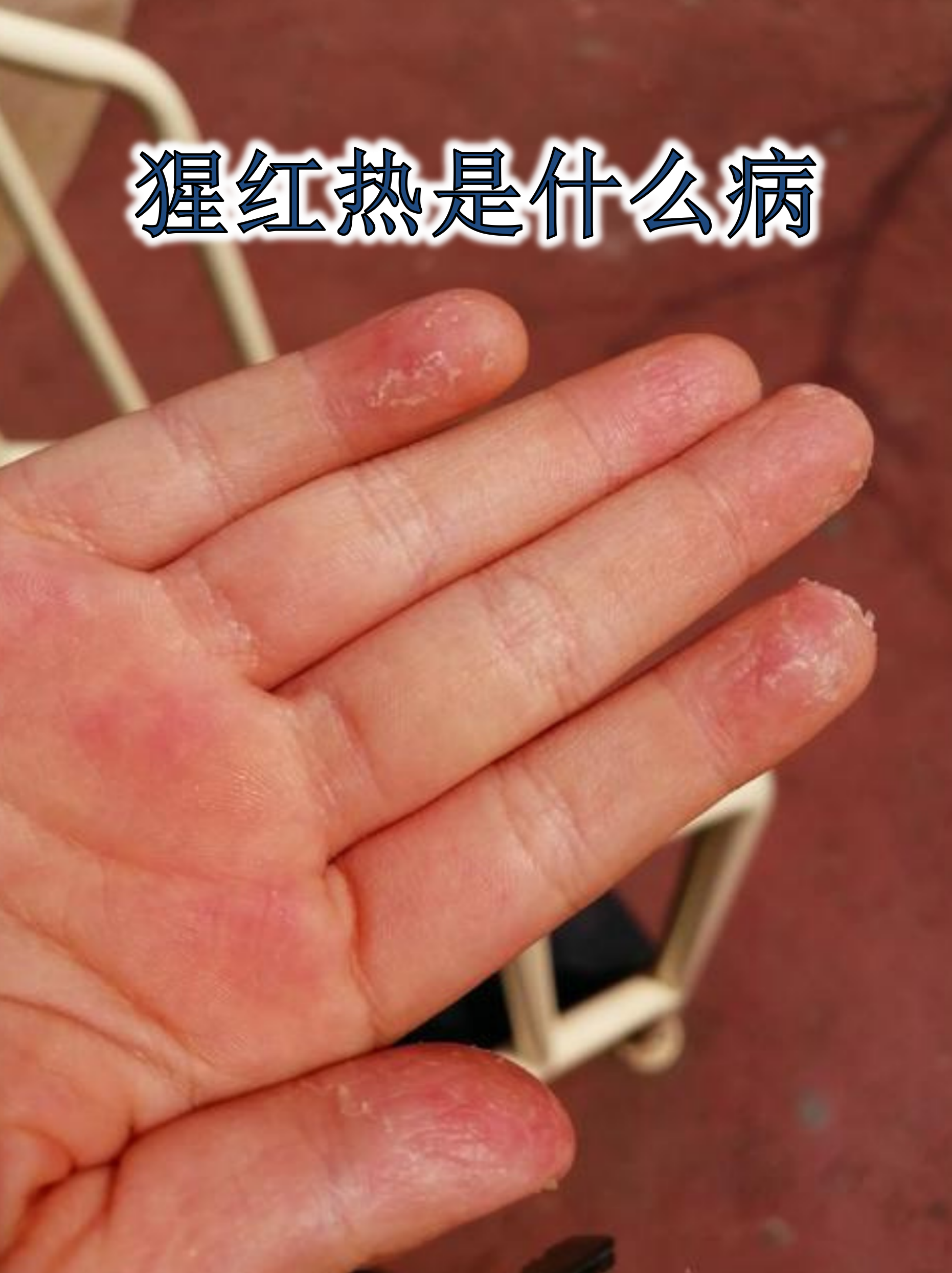 【历史上出血热疫情_出血热最早出现的症状是】 【历史上出血热疫情_出血热最早出现的症状是】