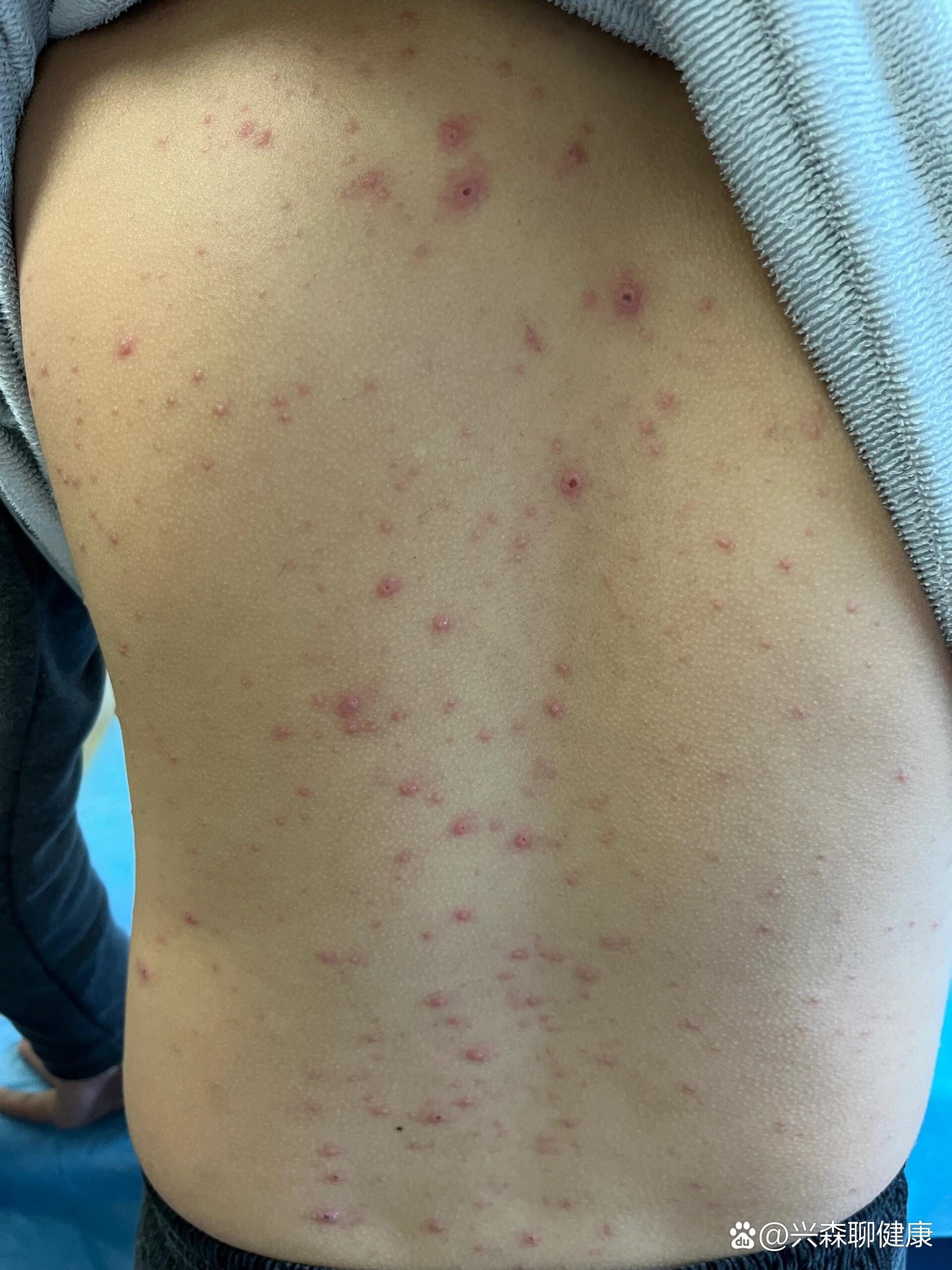 【水痘聚集性疫情/水痘聚集性疫情处置规范】