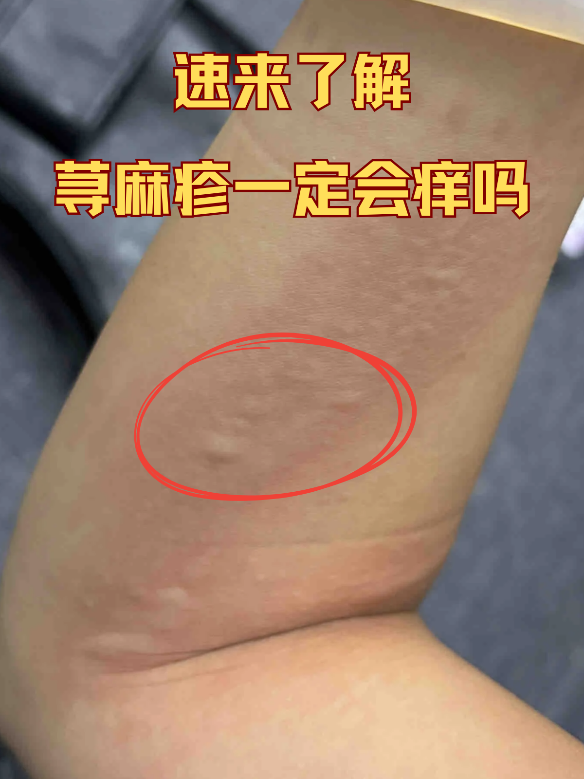 【荨麻疹疫情/荨麻疹疫情最新消息】