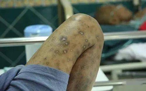 【传染病疫情症状,传染疫情有什么症状】 【传染病疫情症状,传染疫情有什么症状】